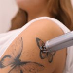 Удаление татуировок в Чебоксарах в "Лекардо Клиник"