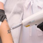 Удаление татуировок в Чебоксарах в "Лекардо Клиник"